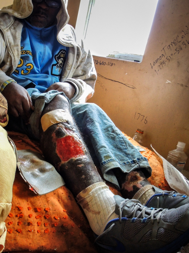 CHICAGO, ILLINOIS - OCTOBER 11, 2014 - Long-time heroin addict, Punchie, laments over the possibility of having to have his leg removed, due to the serious abscesses which he has now developed.