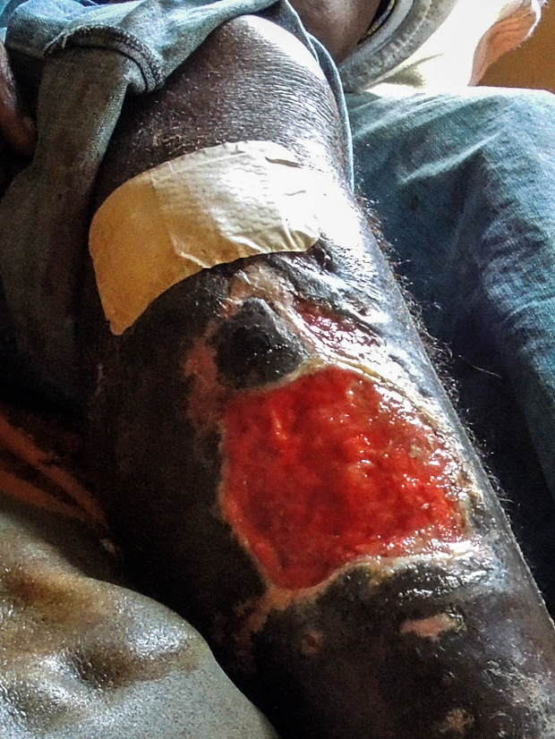 Abscess Update-punchie crop-